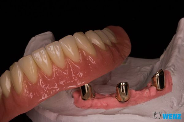 dentalllabor-wenzoliver-wenz-8EFE0C61F-7E7A-D051-5B73-F4E10459F959.jpg
